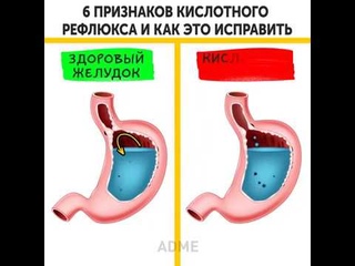 6 признаков кислотного рефлюкса и как это исправить