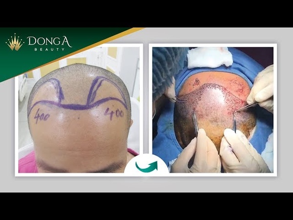 Cấy tóc cho người trán cao tại TMV Đông