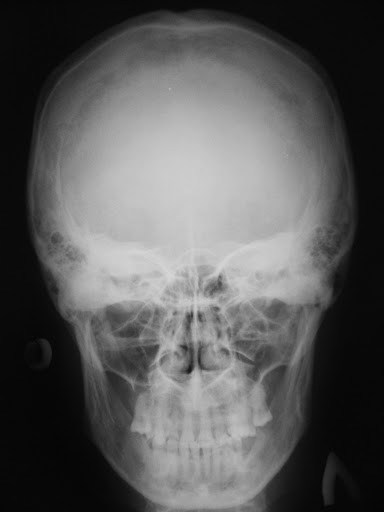 Череп арины глазуновой после падения фото рентгена ЭЛЕГИЯ НА РЕНТГЕНОВСКИЙ СНИМОК МОЕГО ЧЕРЕПА Флейтист хвастлив, а Бог неистов - О