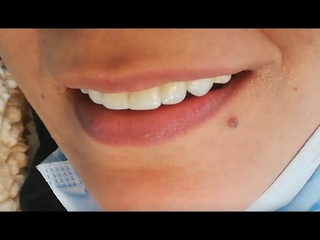 Bridge Teeth Before and After